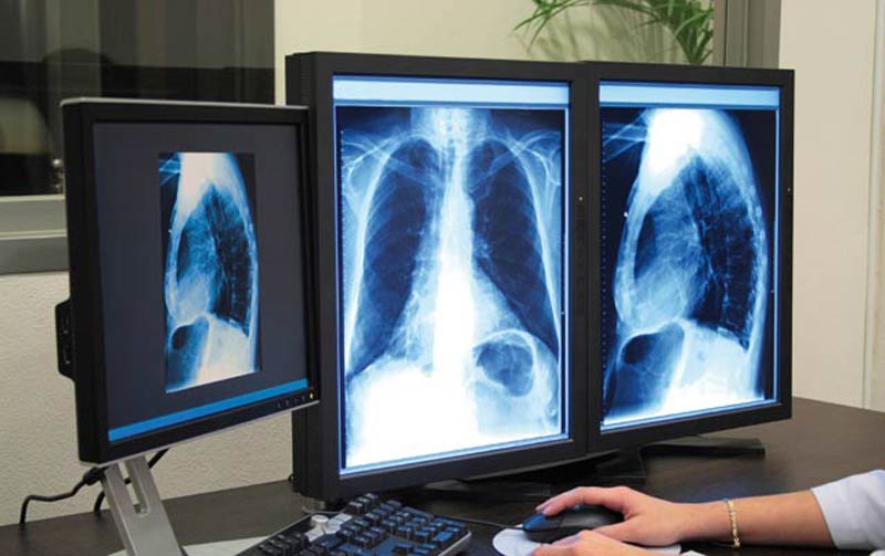 Lutte contre la tuberculose: Louardi se retrousse les manches
