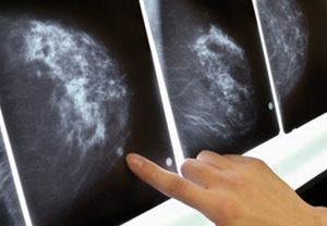 Cancer de l’ovaire : découverte de nouveaux variants génétiques