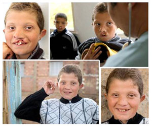 Opération Smile : Plus de 4.500 enfants retrouvent le sourire au Maroc