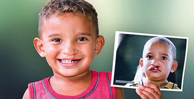 Opération Smile Morocco à Ouarzazate: Plus de 120 enfants retrouveront le sourire