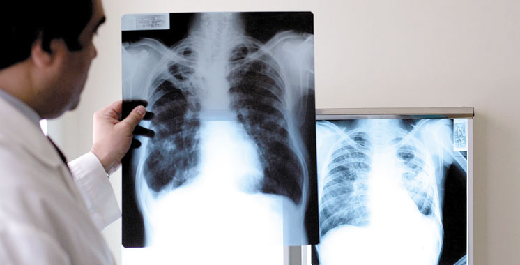 Lutte contre la tuberculose : Pharma 5 sensibilise les patients et le personnel médical