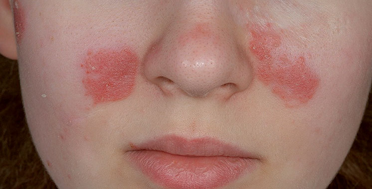 Lupus : Une maladie auto-immune qui touche 20.000 Marocaines