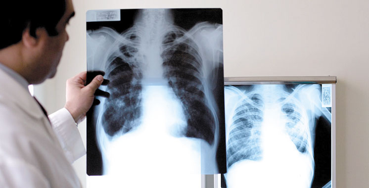 Selon un rapport de l’OMS: 37.000 cas de tuberculose au Maroc