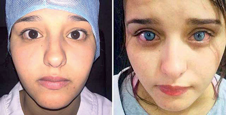 Changer la couleur de ses yeux à vie, c'est désormais possible ! –  Aujourd'hui le Maroc