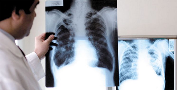 Le ministère renforce le dépistage et la prise en charge  : 53% des nouveaux cas de tuberculose au Maroc sont des formes extra-pulmonaires